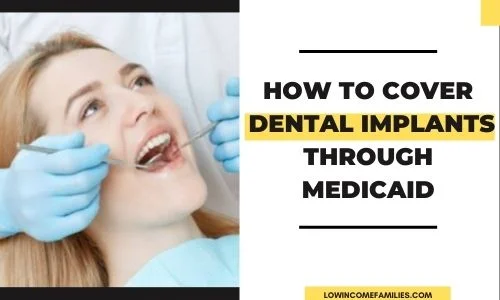 Does medicaid cover dental implants for adults